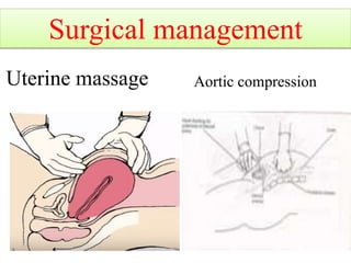 Uterine massage Aortic compression
Surgical management
 
