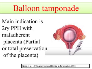 Balloon tamponade
Main indication is
2ry PPH with
maladherent
placenta (Partial
or total preservation
of the placenta)
King et al. 1989; Ambrose and Repke in James et al. 2011
 