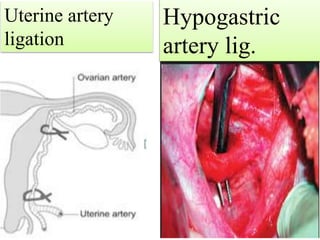 Uterine artery
ligation
Hypogastric
artery lig.
 