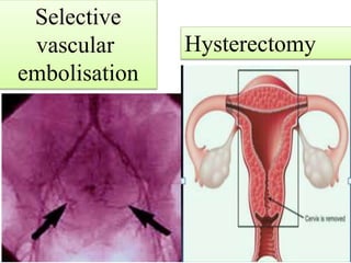 Selective
vascular
embolisation
Hysterectomy
 