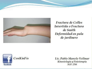 Fractura de Colles 
