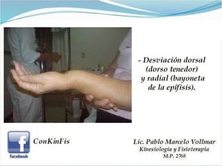 Fractura de Colles 