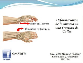 Fractura de Colles 