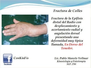 Fractura de Colles 