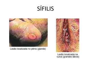 SÍFILIS
 
