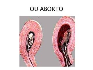 OU ABORTO
 