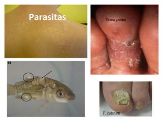 Parasitas
T. rubrum
Tinea pedis
 