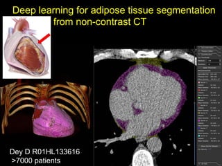 Deep learning for adipose tissue segmentation
from non-contrast CT
Dey D R01HL133616
>7000 patients
 