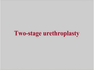 2 stage urethroplasty