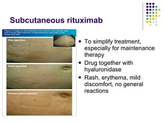 Subcutaneous rituximab To simplify treatment, especially for maintenance therapy Drug together with hyaluronidase Rash, erythema, mild discomfort, no general reactions 