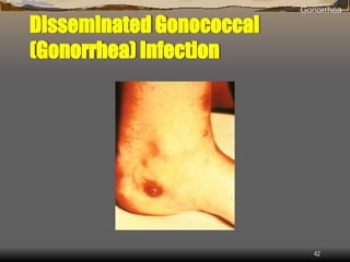 2 sexual transmitted infections Presentation.ppt