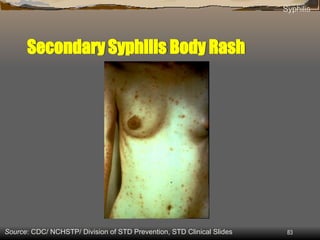 Syphilis Rash Torso 2 sexual transmitted infections Presentation.ppt