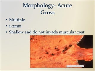 Morphology- Acute Gross Multiple 1-2mm Shallow and do not invade muscular coat 
