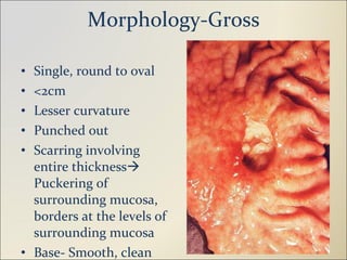 Morphology-Gross Single, round to oval <2cm Lesser curvature Punched out Scarring involving entire thickness   Puckering of surrounding mucosa, borders at the levels of surrounding mucosa Base- Smooth, clean 