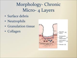 Morphology- Chronic Micr0- 4 Layers Surface debris Neutrophils Granulation tissue Collagen 