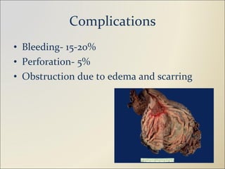 Complications Bleeding- 15-20% Perforation- 5% Obstruction due to edema and scarring 