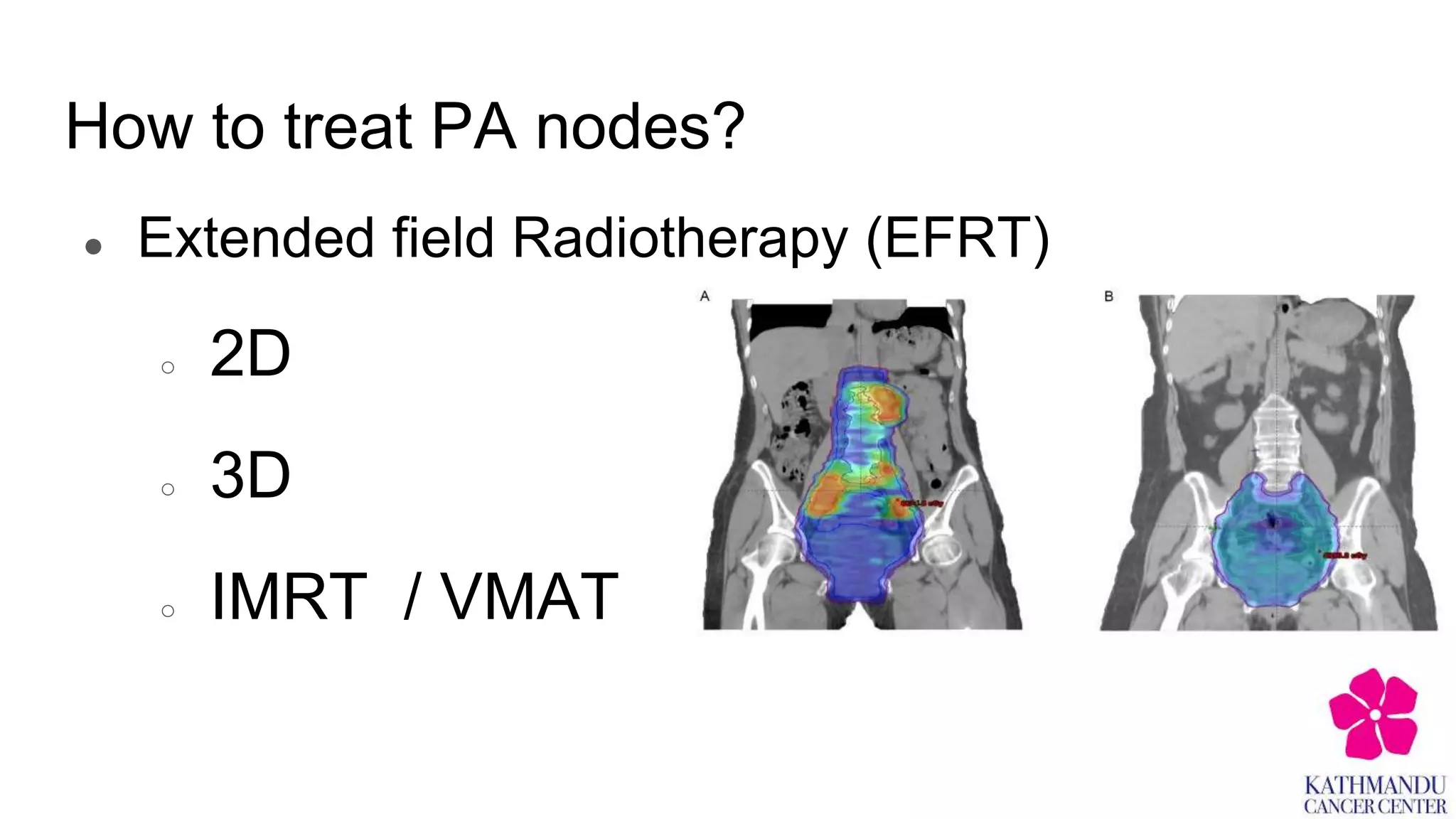 Split Field Radiotherapy Extended field Radiotherapy with chemotherapy in treatment of cervical ...