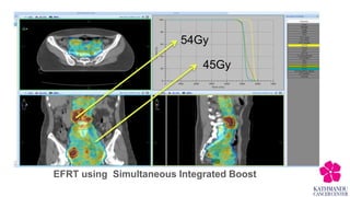 Split Field Radiotherapy Extended field Radiotherapy with chemotherapy in treatment of cervical ...