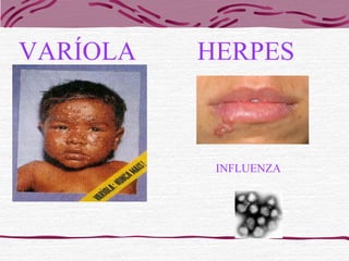 VARÍOLA HERPES
INFLUENZA
 