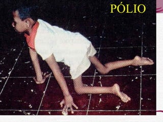 PÓLIO
 
