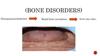 Osteoporosis/Arthiritis Rapid bone resorption Knife edge ridges
 