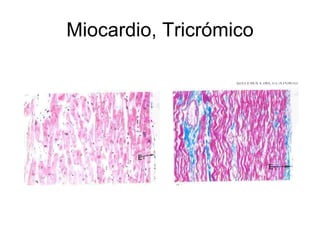 Miocardio, Tricrómico 