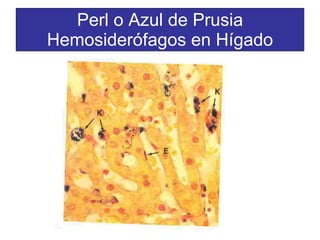 Perl o Azul de Prusia Hemosiderófagos en Hígado 
