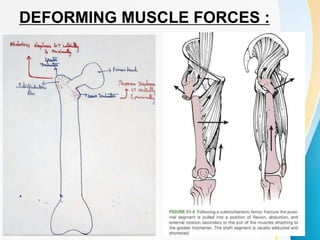 DEFORMING MUSCLE FORCES :
 