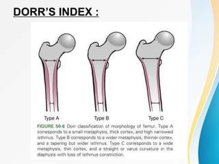 DORR’S INDEX :
 