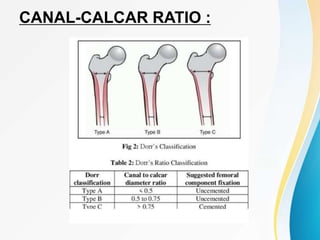 CANAL-CALCAR RATIO :
 