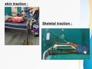 skin traction :
Skeletal traction :
 