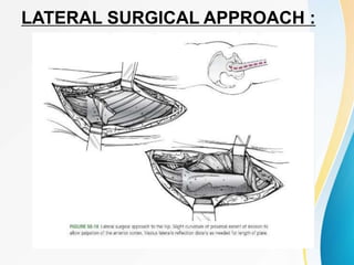 LATERAL SURGICAL APPROACH :
 