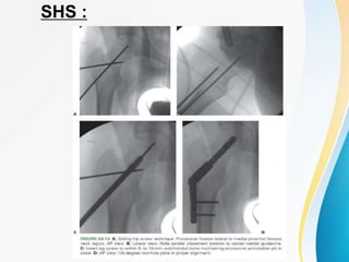 SHS :
 