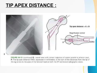 TIP APEX DISTANCE :
 