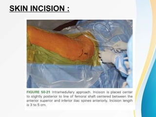 SKIN INCISION :
 