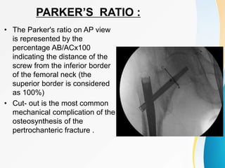 PARKER’S RATIO :
• The Parker's ratio on AP view
is represented by the
percentage AB/ACx100
indicating the distance of the
screw from the inferior border
of the femoral neck (the
superior border is considered
as 100%)
• Cut- out is the most common
mechanical complication of the
osteosynthesis of the
pertrochanteric fracture .
 