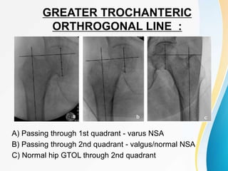 GREATER TROCHANTERIC
ORTHROGONAL LINE :
A) Passing through 1st quadrant - varus NSA
B) Passing through 2nd quadrant - valgus/normal NSA
C) Normal hip GTOL through 2nd quadrant
 