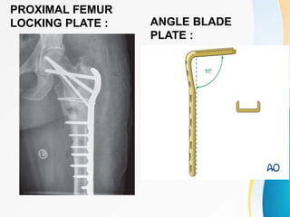 PROXIMAL FEMUR
LOCKING PLATE : ANGLE BLADE
PLATE :
 