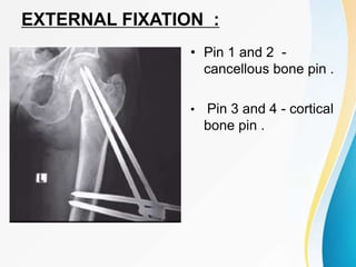 EXTERNAL FIXATION :
• Pin 1 and 2 -
cancellous bone pin .
• Pin 3 and 4 - cortical
bone pin .
 