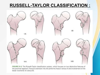 RUSSELL-TAYLOR CLASSIFICATION :
 