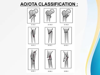 AO/OTA CLASSIFICATION :
 