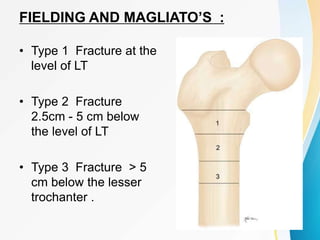 FIELDING AND MAGLIATO’S :
• Type 1 Fracture at the
level of LT
• Type 2 Fracture
2.5cm - 5 cm below
the level of LT
• Type 3 Fracture > 5
cm below the lesser
trochanter .
 