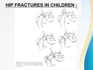 HIP FRACTURES IN CHILDREN :
 