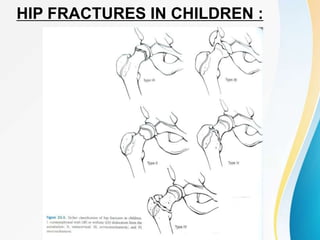 HIP FRACTURES IN CHILDREN :
 