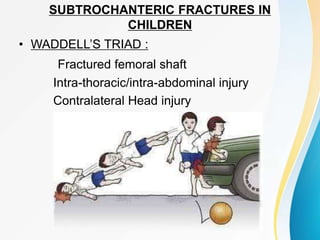 SUBTROCHANTERIC FRACTURES IN
CHILDREN
• WADDELL’S TRIAD :
Fractured femoral shaft
Intra-thoracic/intra-abdominal injury
Contralateral Head injury
 