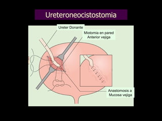 Ureteroneocistostomia Ureter Donante Miotomia en pared Anterior vejiga Anastomosis a Mucosa vejiga