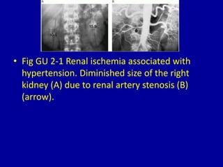 • Fig GU 2-1 Renal ischemia associated with
hypertension. Diminished size of the right
kidney (A) due to renal artery stenosis (B)
(arrow).
 