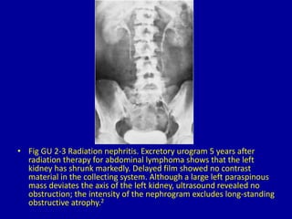 • Fig GU 2-3 Radiation nephritis. Excretory urogram 5 years after
radiation therapy for abdominal lymphoma shows that the left
kidney has shrunk markedly. Delayed film showed no contrast
material in the collecting system. Although a large left paraspinous
mass deviates the axis of the left kidney, ultrasound revealed no
obstruction; the intensity of the nephrogram excludes long-standing
obstructive atrophy.2
 