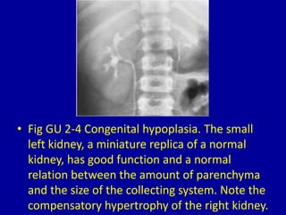 • Fig GU 2-4 Congenital hypoplasia. The small
left kidney, a miniature replica of a normal
kidney, has good function and a normal
relation between the amount of parenchyma
and the size of the collecting system. Note the
compensatory hypertrophy of the right kidney.
 