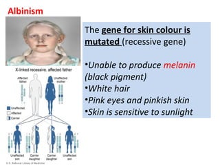 Albinism
The gene for skin colour is
mutated (recessive gene)
•Unable to produce melanin
(black pigment)
•White hair
•Pink eyes and pinkish skin
•Skin is sensitive to sunlight
 